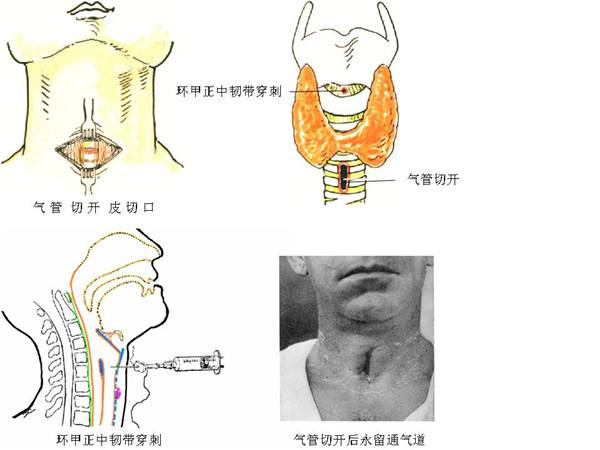 環(huán)甲膜穿刺針基本簡(jiǎn)介